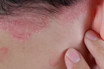 What to Do if You Have Eczema